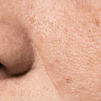 Clogged Pores