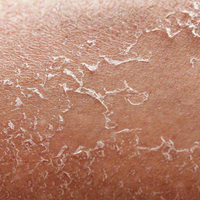 Cracked, Damaged Skin