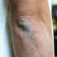 Cracked Elbows, Knees, Heels