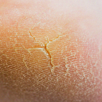 Cracked Heels & Elbows