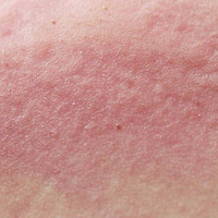 Eczema-Prone Dryness