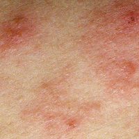 Eczema-Prone Patches