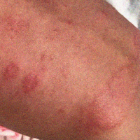 Eczema & Dermatitis