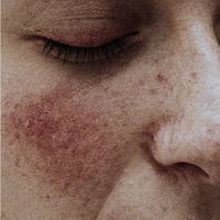Redness and Irritation