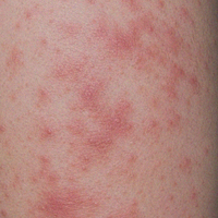 Eczema-Prone Skin