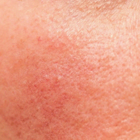 Rosacea-Prone Skin