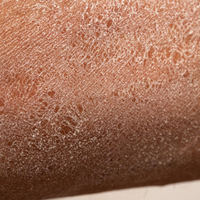 Severe Dryness