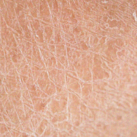 Very Dry, Rough Skin