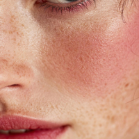 Visible Redness