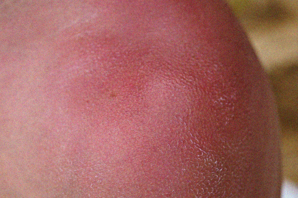 Visible Redness