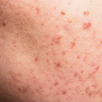 Weakened Skin Barrier