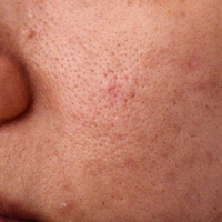 Weakened Skin Barrier